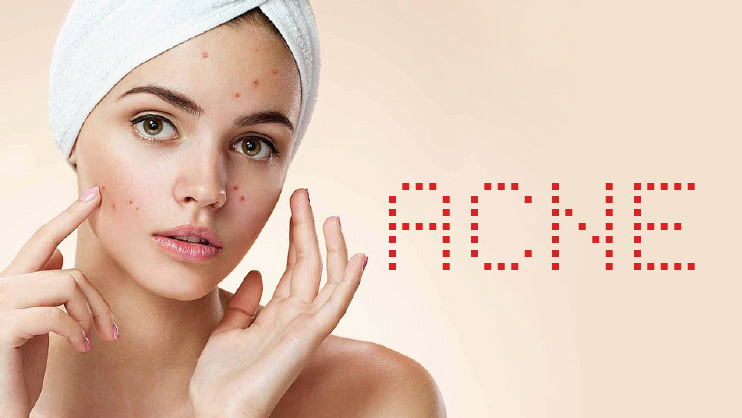 What Is Acne?