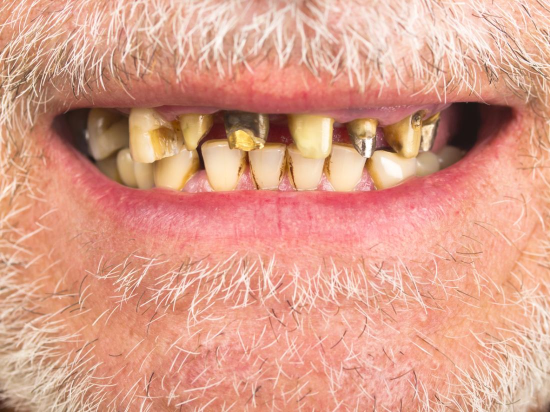 Everything You Need To Know About Scurvy