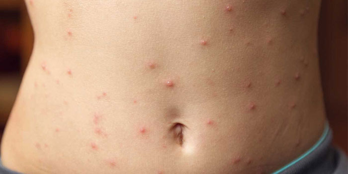 Allergies: Symptoms, Causes And Treatment