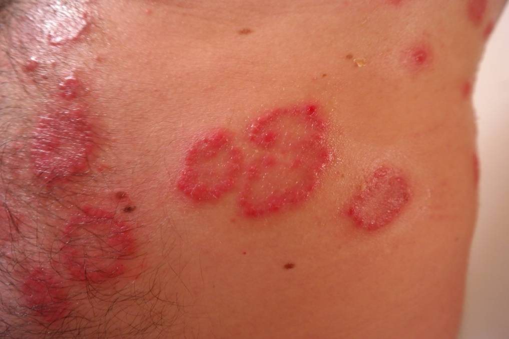 What Are Rashes?