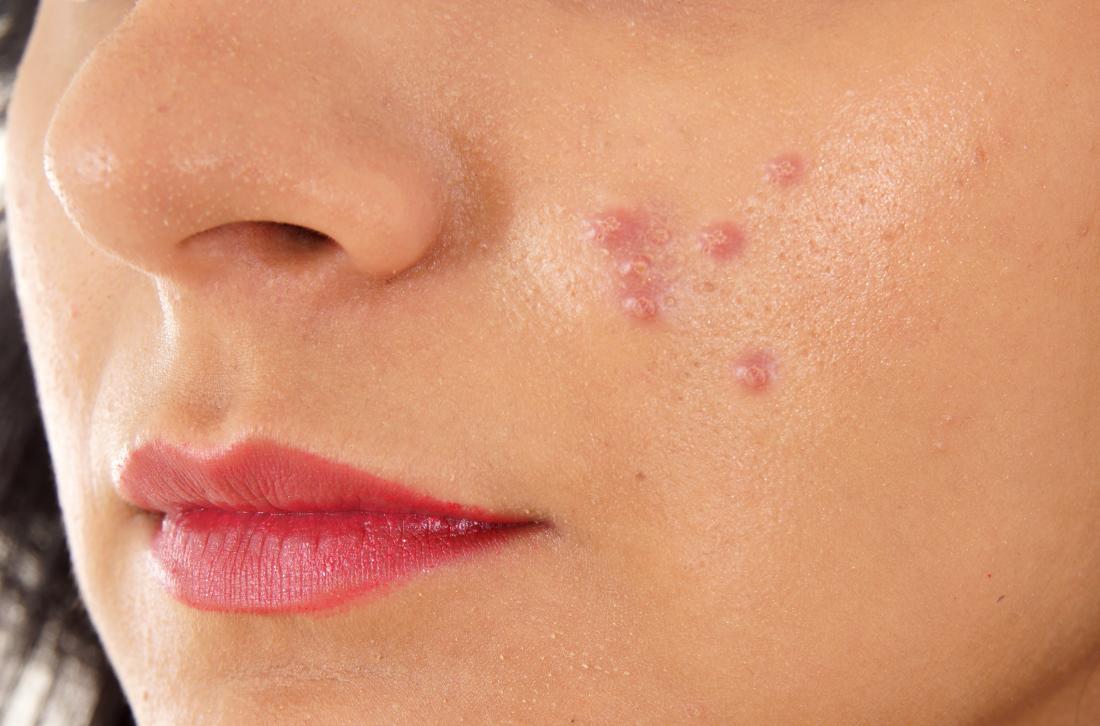 Ways To Get Rid Of Pimples