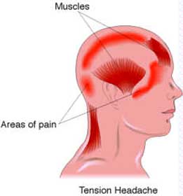 Tension Headaches