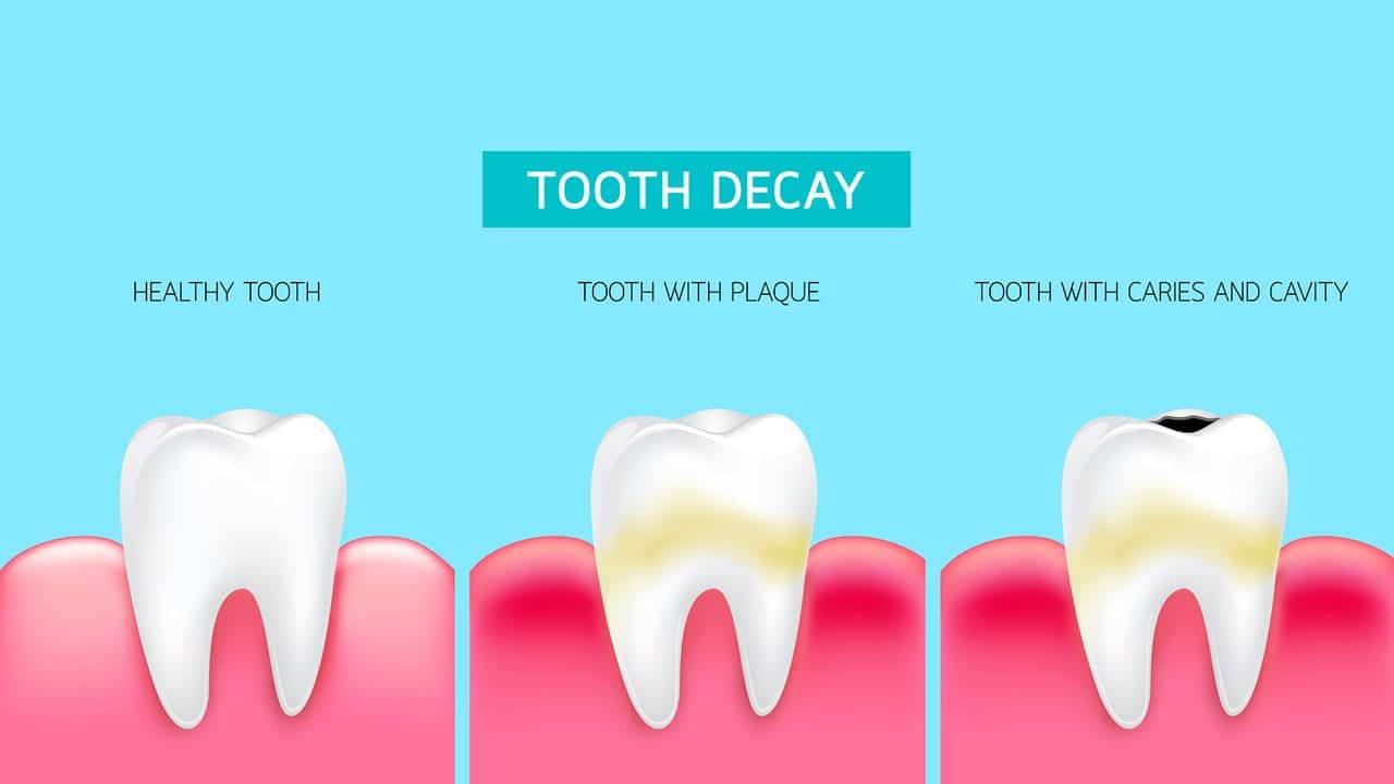 What Are Cavities?