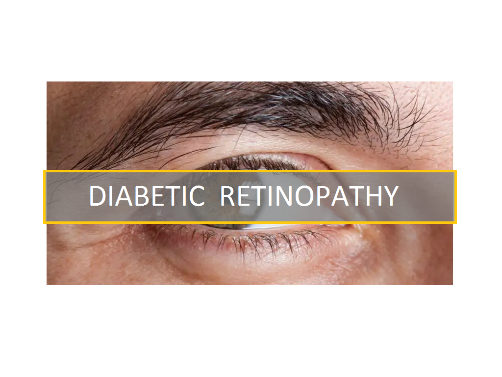 Diabetic Retinopathy : What You Should Know