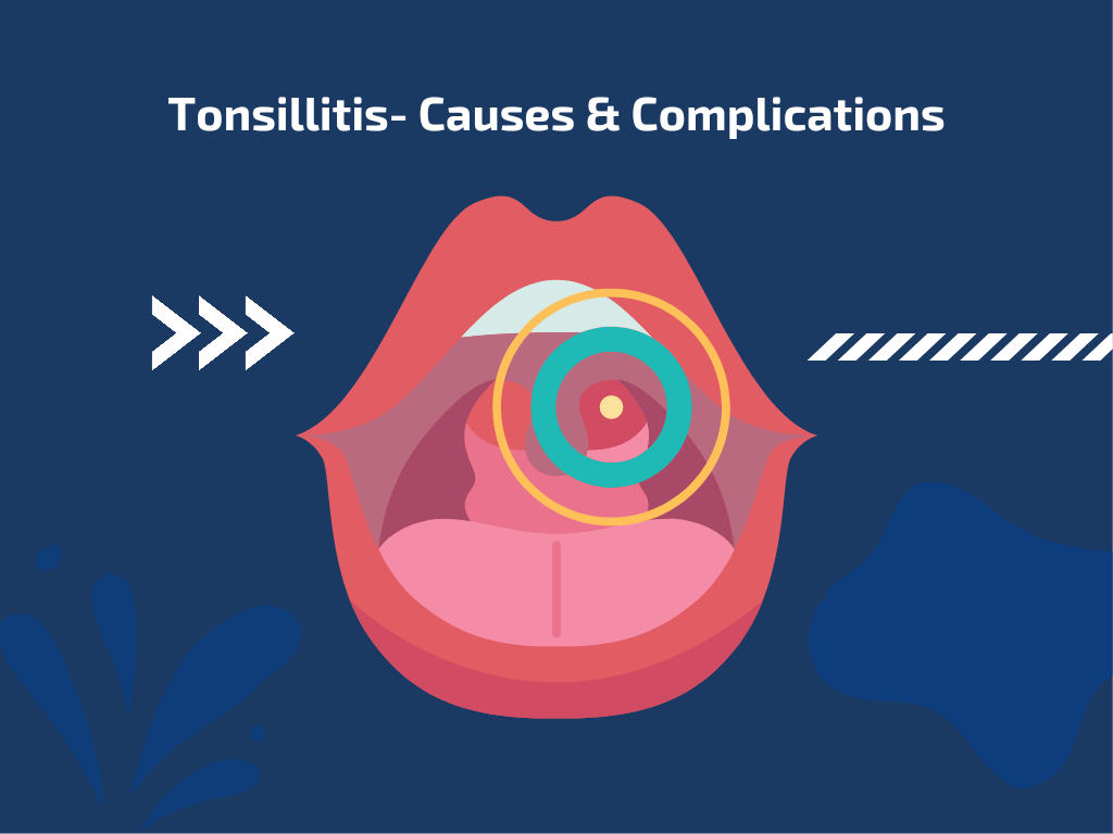 Tonsillitis- Causes & Complications