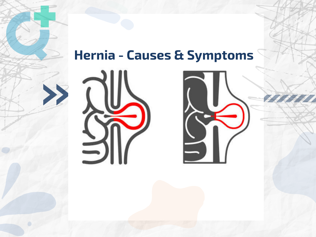 Hernia - All You Need To Know