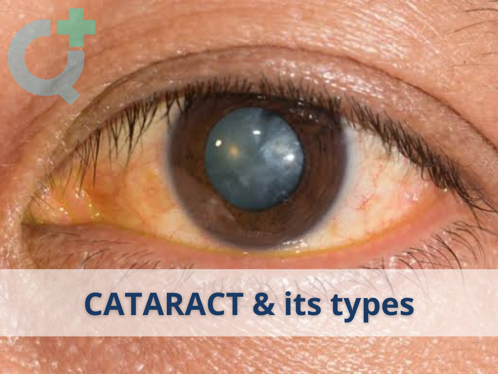 All You Need To Know About Cataract