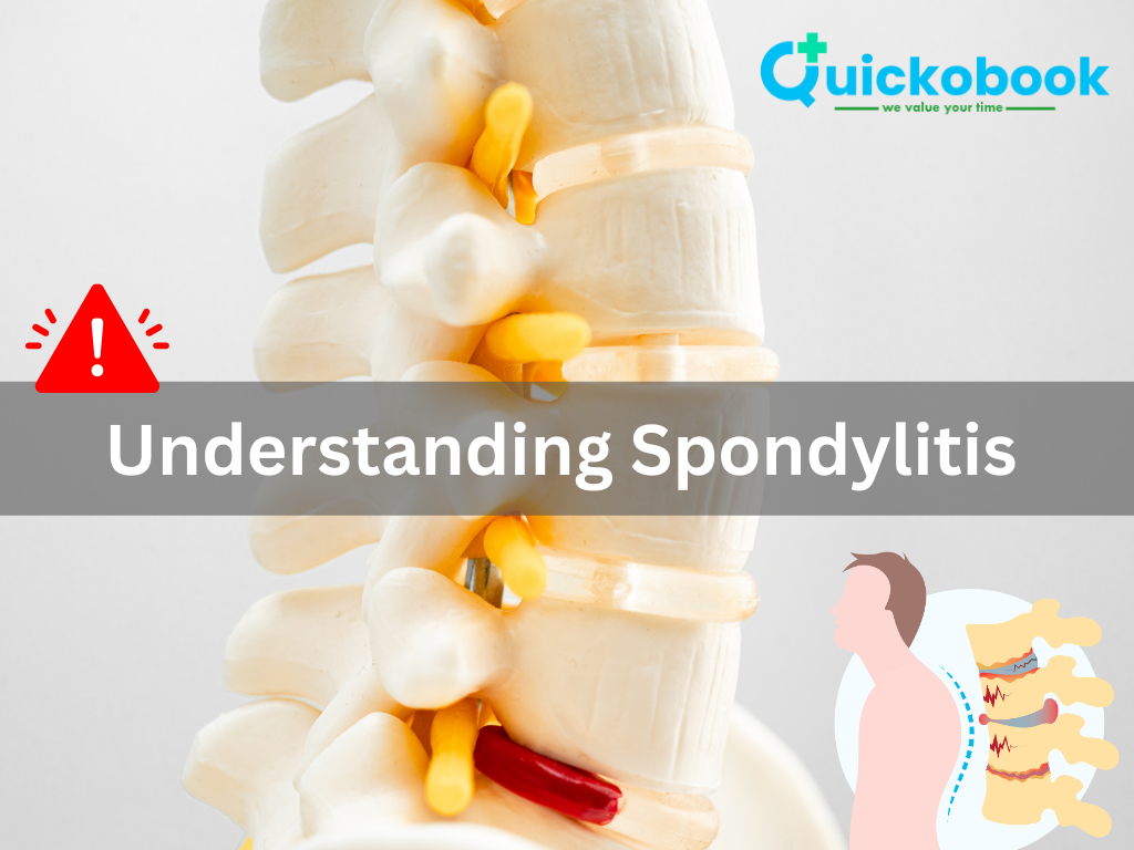 Understanding Spondylitis : Symptoms, Causes, And Management