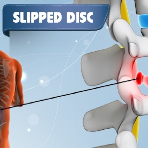 Slipped Disc