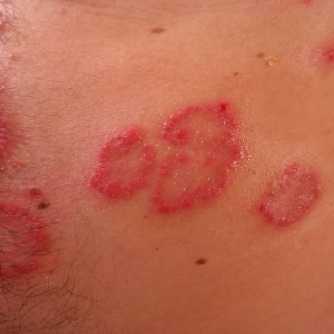 What Are Rashes?