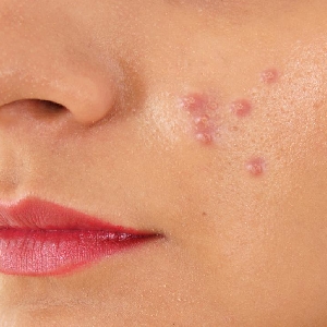Ways To Get Rid Of Pimples