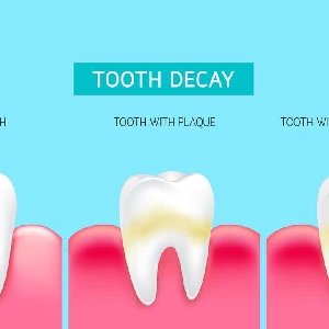 What Are Cavities?